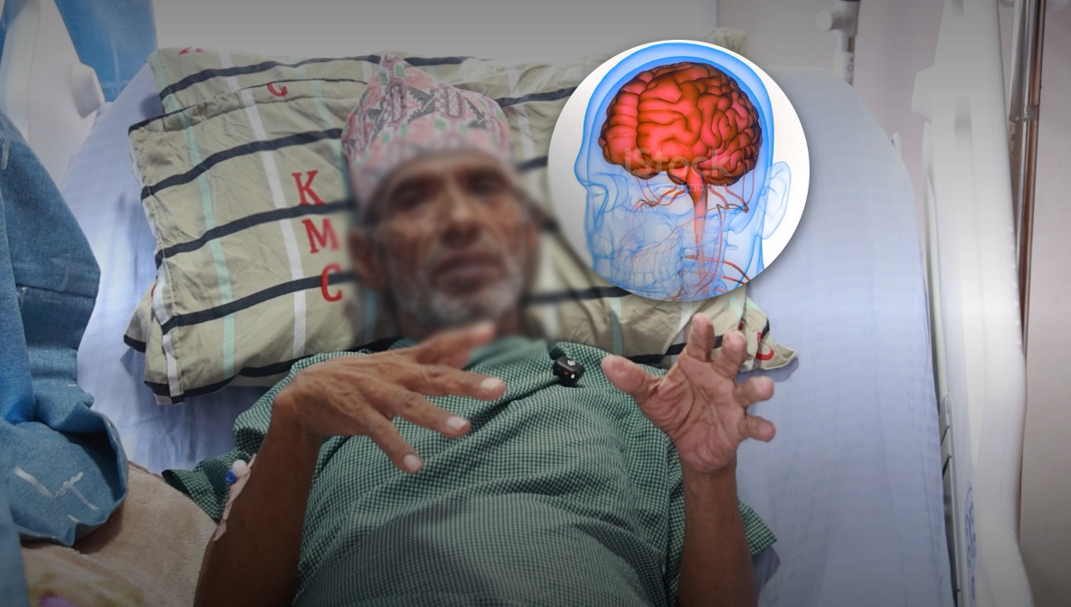 केएमसीमा मस्तिष्कको जटिल ‘एभीएम’को विना चिरफार सफल उपचार