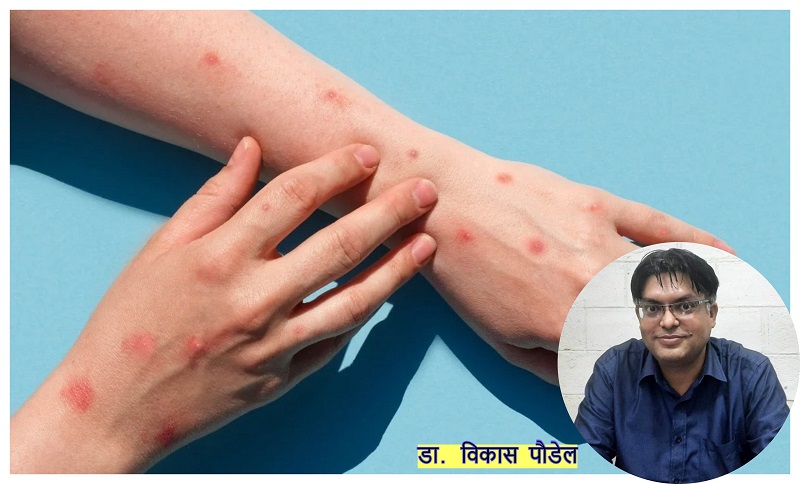 के हो मङ्कीपक्स ? कसरी जोगिने ?
